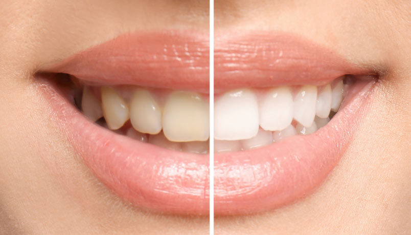 Closeup View Of Before And After Teeth